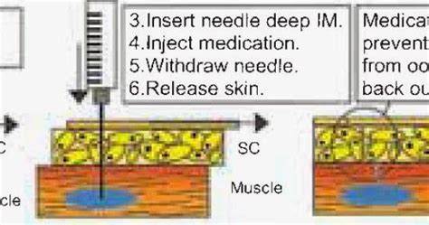 Z-Track Method for Giving IM Injections 1. Identify injection site. 2. Pull skin to one side. 3 ...