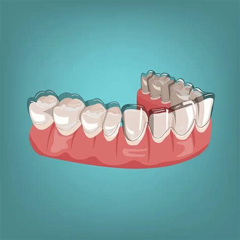 Can Invisalign Fix Crowding? Aligning Teeth Without Braces