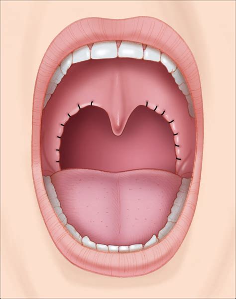 Palate Surgery - Tonsillectomy | Stanford Health Care