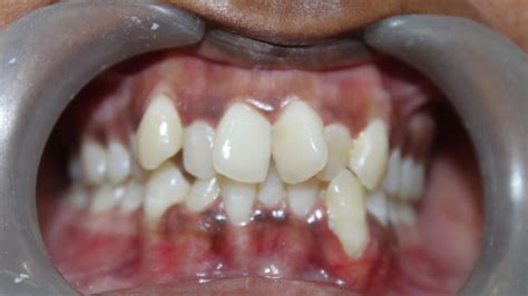 What are Crowded Teeth? - West Hollywood Holistic and Cosmetic Dental Care