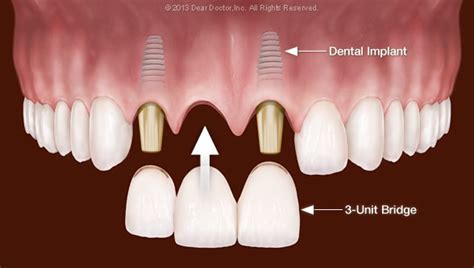 Dental Bridge vs Implant – Smile Place Dental