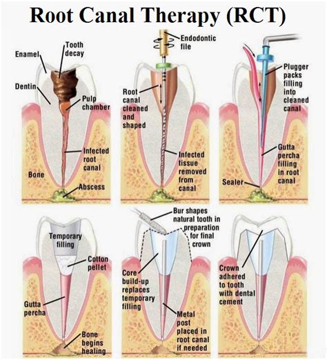 Root Canal Therapy | Orwigsburg, Pennsylvania | Sweet Tooth Dental