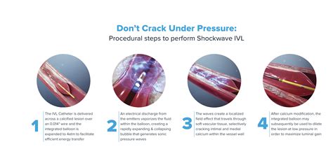 SHOCKWAVE IVL (IntraVascular Lithotripsy) — Golden Shutter Films