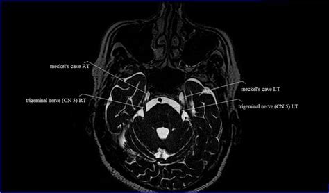 Cranial Nerve 6 Mri