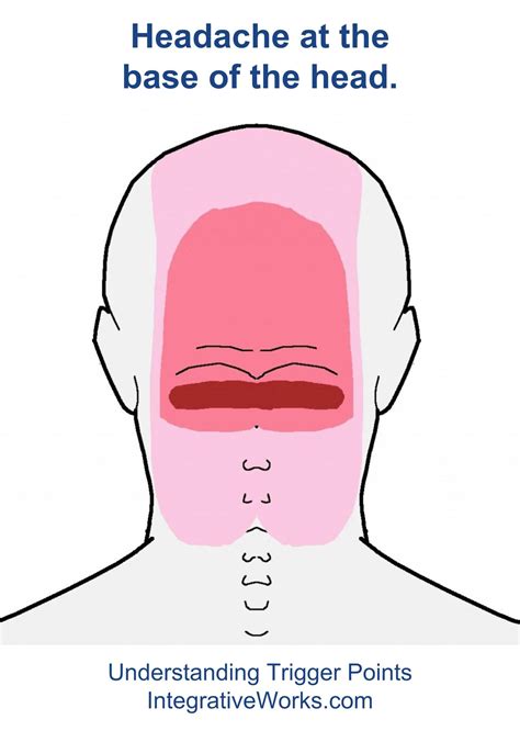 Headache at the Base of The Head Cervicogenic Headache | Headache ...