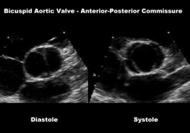 Bicuspid Aortic Valve Workup: Laboratory Studies, Imaging Studies ...