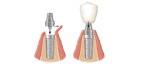 What is osseointegration - Why Dental Implants