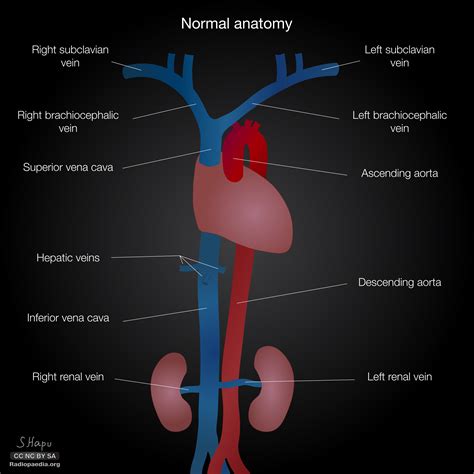 Radiopaedia - Drawing Venae cavae, aorta and large vessels - English labels | AnatomyTOOL