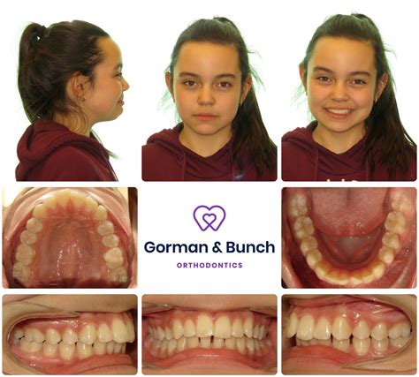 Invisalign Before and After Stories With Our Patients – Gorman & Bunch