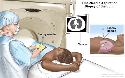 Malignant Mesothelioma Treatment - NCI