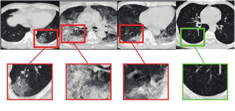 [4] Chest CT images of laboratory-confirmed COVID-19 patient and one ...