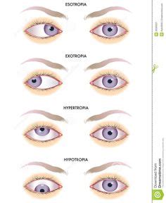 Lesions of the facial nerve - UMN vs LMN | Facial nerve, Speech language pathology, Speech pathology