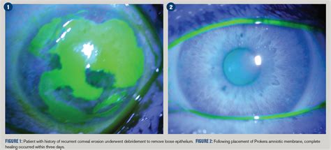 Slit Lamp Exam Corneal Abrasion