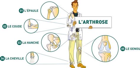 Les traitements non chirurgicaux de l'arthrose - Dr Mylle à Paris