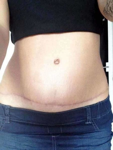 tummy tuck scars picture after 2 years » Tummy Tuck: Prices, Photos, Reviews, Info, Q&A