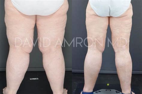 lipedema treatment before and after - gooden-mezquita