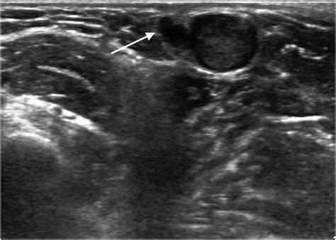 Ultrasonographic Features of Eccrine Spiradenoma - Hwang - 2018 ...