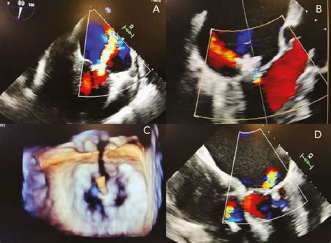 MitraClip Procedure and Result | Download Scientific Diagram