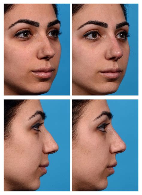 Fillers For Nose Before And After - Injectable Nose Job Rhinoplasty Without Surgery Sisu : View ...