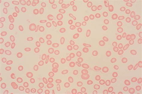 Anemia, hypochromic; Chlorosis