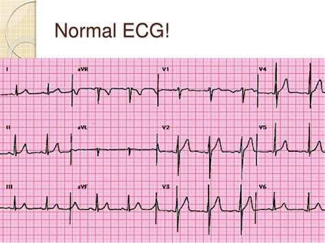 PPT - ECG interpretation for beginners Part 3 - Bradyarrhythmias PowerPoint Presentation - ID:158944