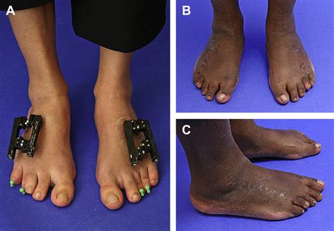 Figure 8 from Problems, obstacles, and complications of metatarsal ...