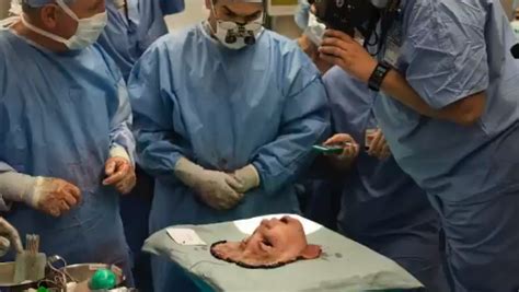 Face Transplant: How Surgeons Graft A Dead Donor's Face On a Living ...