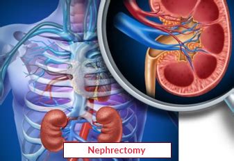 Nephrectomy Procedure | Partial Nephrectomy Surgery