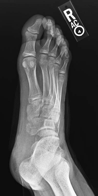 Os Navicular: Accessory Bone Removal - Dominic Carreira, MD - Atlanta