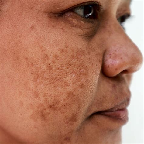 Know all about uneven skin tone and pigmentation