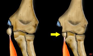 Avulsion Fracture Elbow