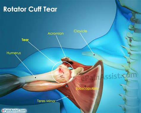 The 5 Most Common Injuries of Serious Lifters