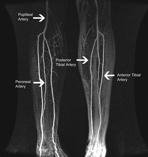 Preoperative MR Angiography in Free Fibula Flap Transfer for Head and Neck Cancer: Clinical ...