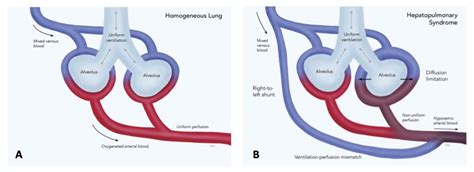 Hepatopulmonary Syndrome - OpenAnesthesia