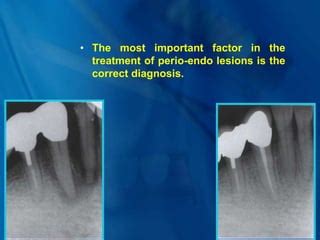 Endo – Perio lesions.ppt