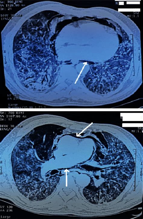 Spontaneous pneumomediastinum With COVID-19 pneumonia.