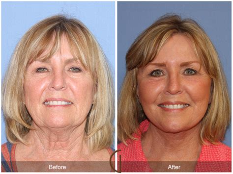 Dr. Kevin Sadati Releases Tip Sheet on Facelift vs. Neck Lift: When A ...