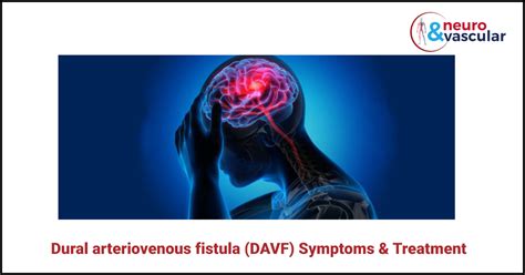 Dural arteriovenous fistula (DAVF) Symptoms and Treatment