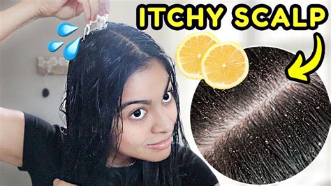 How I GET RID OF DANDRUFF in one hair wash! *lemon juice treatment ...