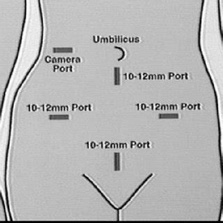 Diagram of placement of five ports for sigmoid colectomy. | Download Scientific Diagram