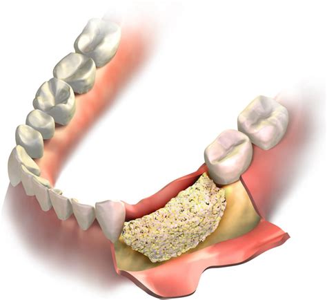 Tips for Speedy Dental Bone Graft Recovery | bellevuerx.com