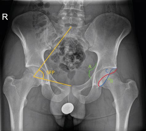 Figure 1 from Spinopelvic Characteristics in Acetabular Retroversion ...