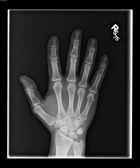 Triquetral fracture - X Rays Case Studies - CTisus CT Scanning