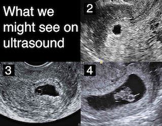 Patience is key: Understanding the timing of early ultrasounds | Your ...