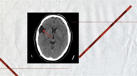 Arachnoid cysts: Symptoms, treatment and more