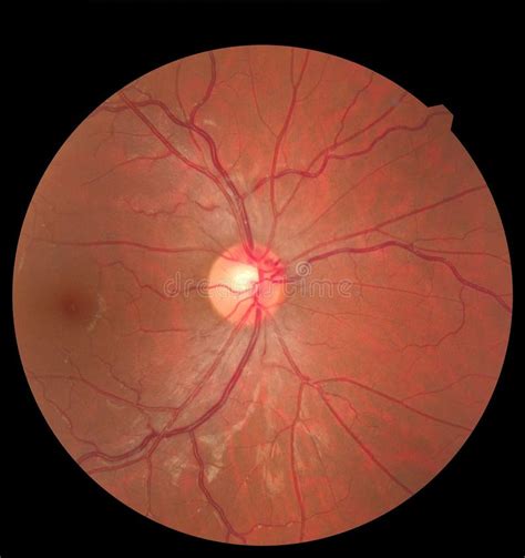 Ophthalmic Image Detailing the Retina and Optic Nerve Inside a Healthy Human Eye. Health ...