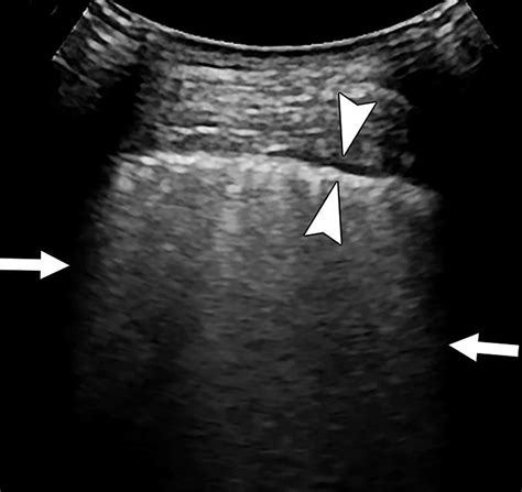 Lung Ultrasound Reveals Duration and Severity of COVID-19