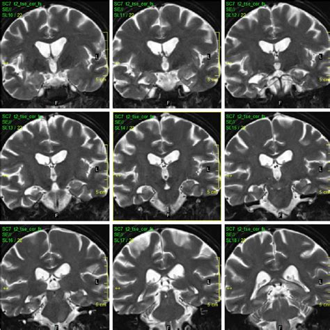 Last MRI (2015). Notes: On the last MRI, diffuse brain atrophy and ...