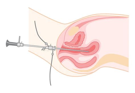 Hysteroscopy of Female Reproductive System Treat Examine Diagnostic Uterus. Side View in a Cut ...