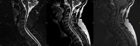 Imaging of the Spine at 3 Tesla | Radiology Key